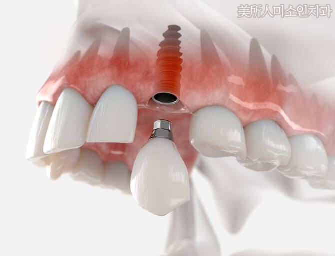 임플란트 보험 임플란트 가격 임플란트 비용 치아 보험 추천 치과 보험 추천 임플란트 치아 보험 치아 보험 적용 기과 보험 적용 치과 보험 임플란트 임플란트 치아