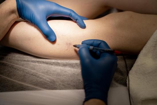 경화요법(Sclerotherapy) – 작은 정맥 치료