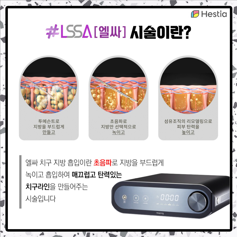 엘싸시술이란?