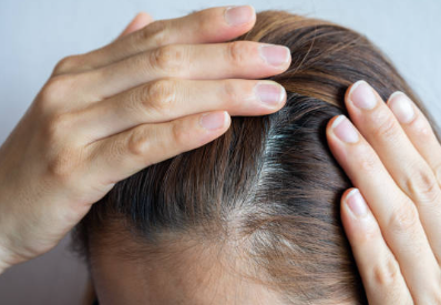 여성 탈모