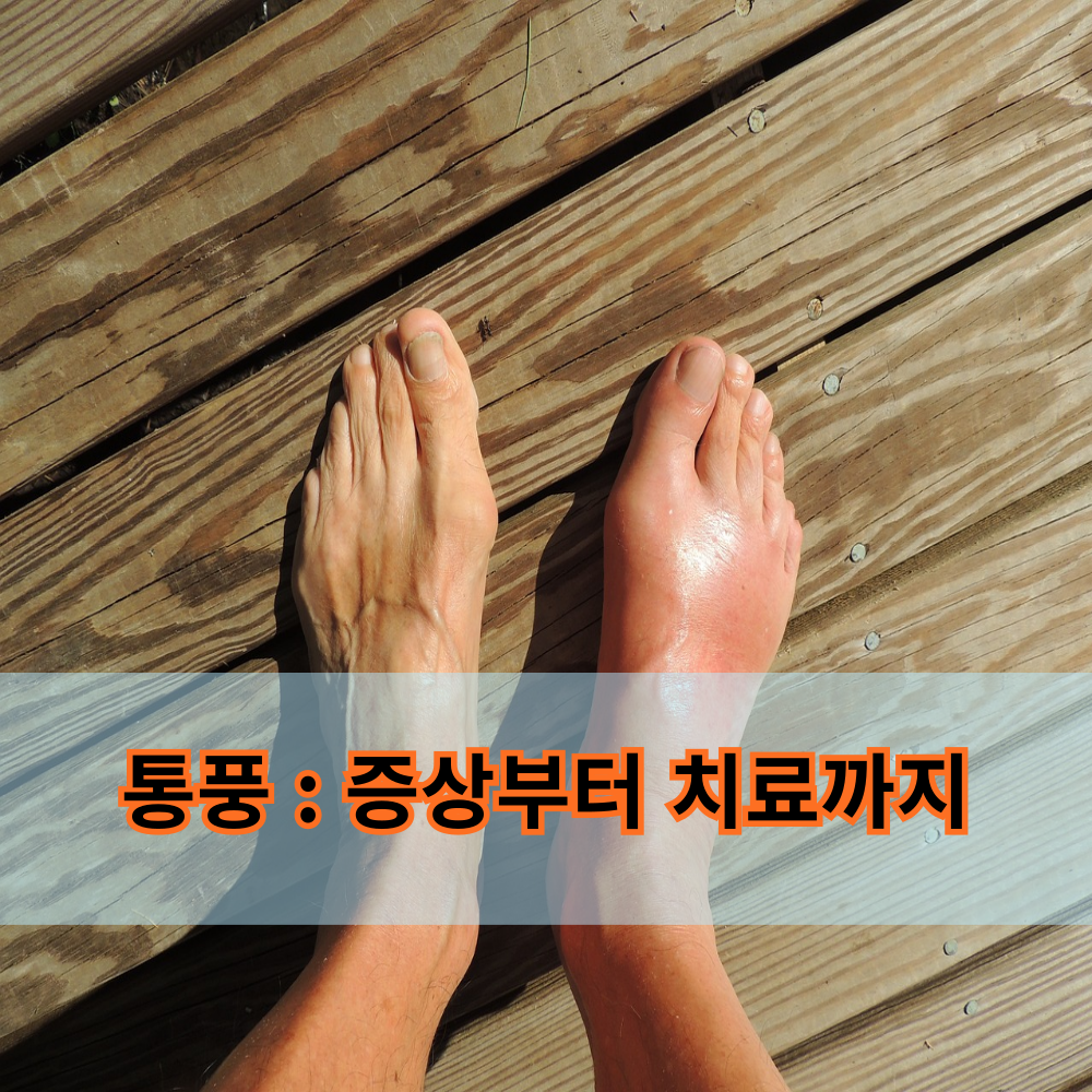 통풍 증상 및 치료