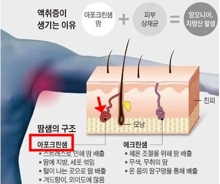 액취증