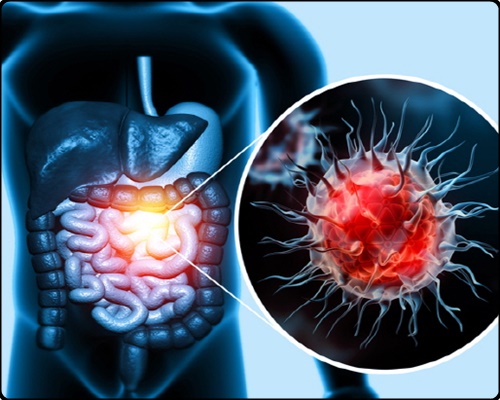 대장암 초기증상