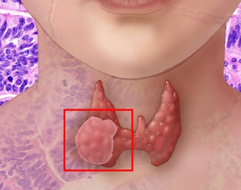 갑상선암 흉터 부위