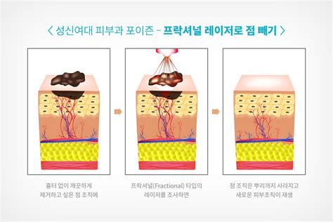 눈비립 종 제거