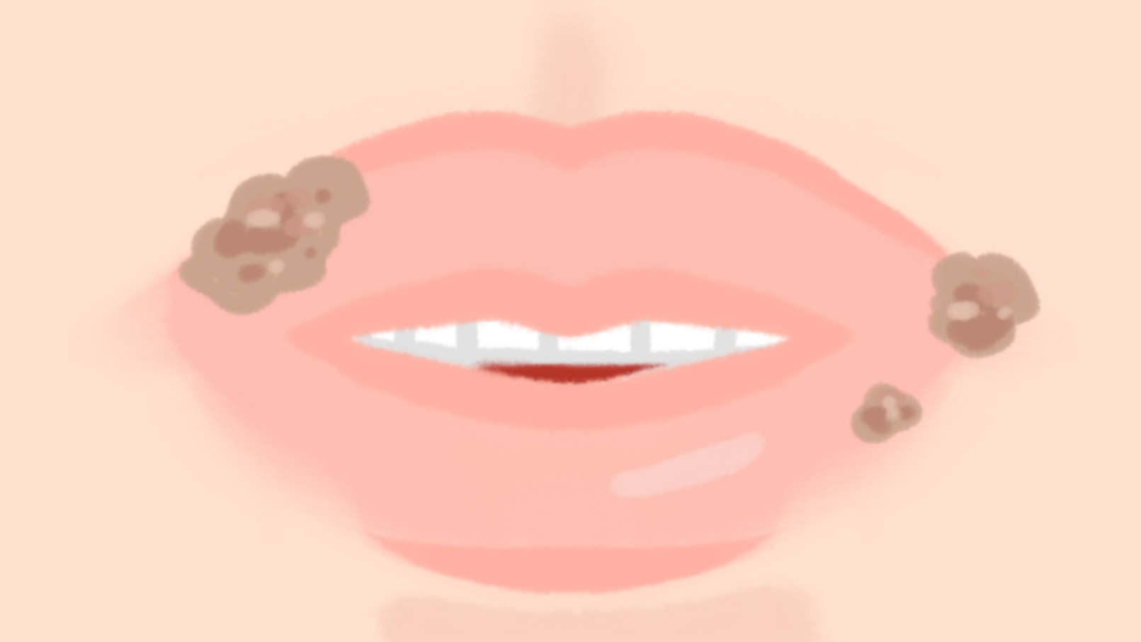 입술 헤르페스 전염 될까?