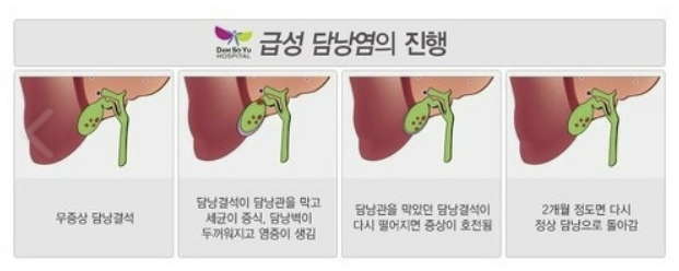 담낭염의 증상, 제거 수술, 치료 원인 좋은 음식 알아보기