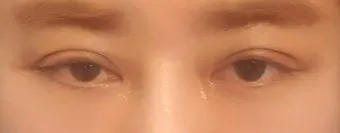 눈물샘 뚫는 수술 간단한가요에 대한 수술정보_12