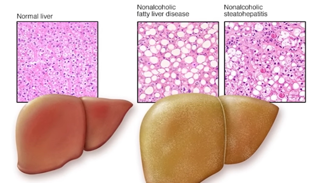 지방간 없애는 방법
