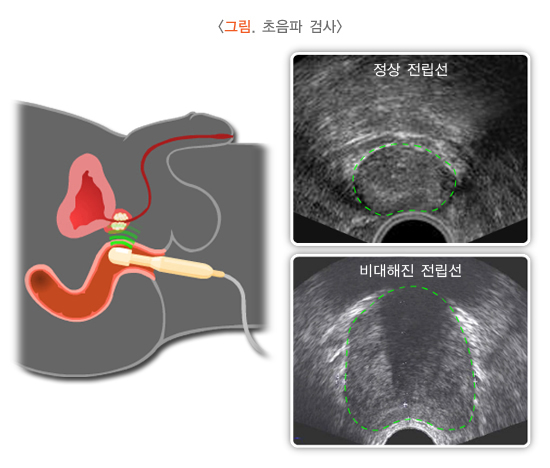 전립선초음파검사를-표현한-그림