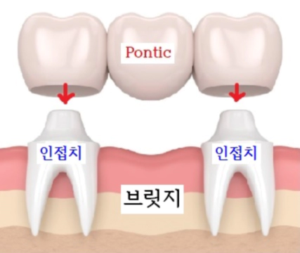 브릿지의 구조 이미지
