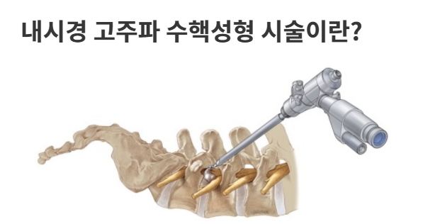 내시경 고주파수술