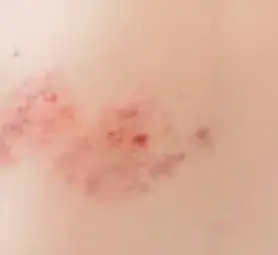 대상포진