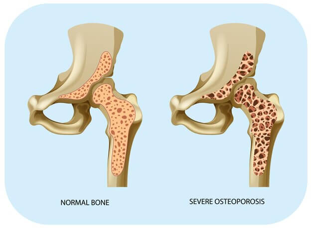 골다공증 예방을 위한 뼈 건강 식단 가이드