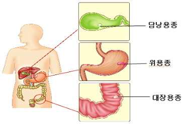 위 사진/ 출처 - 가톨릭대학교성모병원