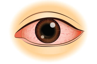 안구건조증의 증상 충혈