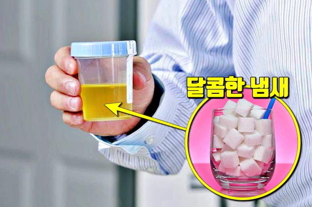 소변에서 냄새가 나는 이유 당뇨 증상, 건강 팁줌