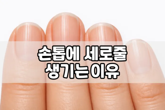 손톱에 세로줄이 생기는 이유