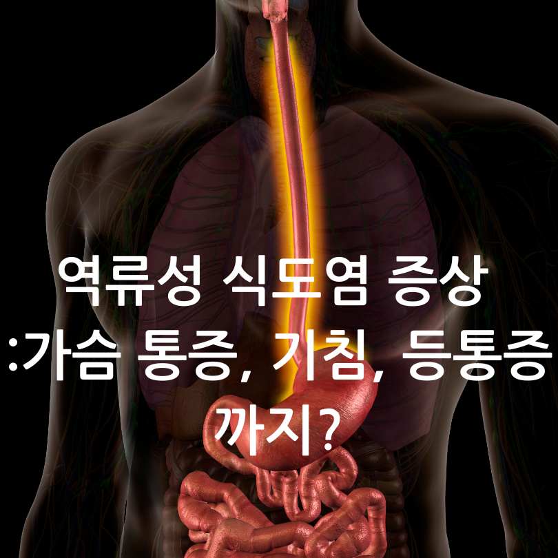 역류성 식도염 증상 총정리