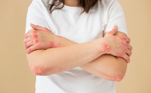 땀띠-자연-치유-치료-법-1