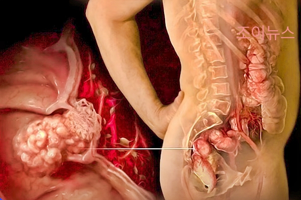 직장암_출처:유튜브응꼬형