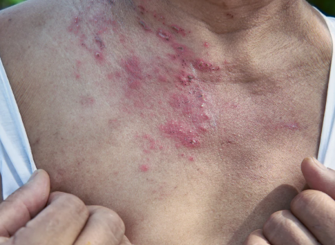 몸이 가려워 잠 못자고 있어요, 소양증입니다.