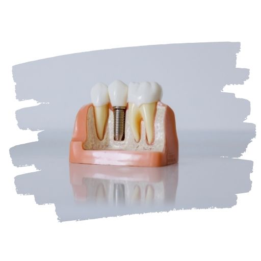 평택 임플란트 잘하는 곳