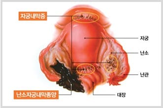 자궁내막증&amp;#44; 자궁내막증 증상&amp;#44; 자궁내막 증식증&amp;#44; 자궁내막 증식증 치료방법&amp;#44; 자궁내막증에 좋은 음식&amp;#44; 자궁내막 증식증 보험&amp;#44; 자궁내막증 피임약&amp;#44; 자궁내막증 한방치료&amp;#44; 자궁내막증 비잔&amp;#44; 자궁내막 증식증 원인&amp;#44; 자궁내막증 수술