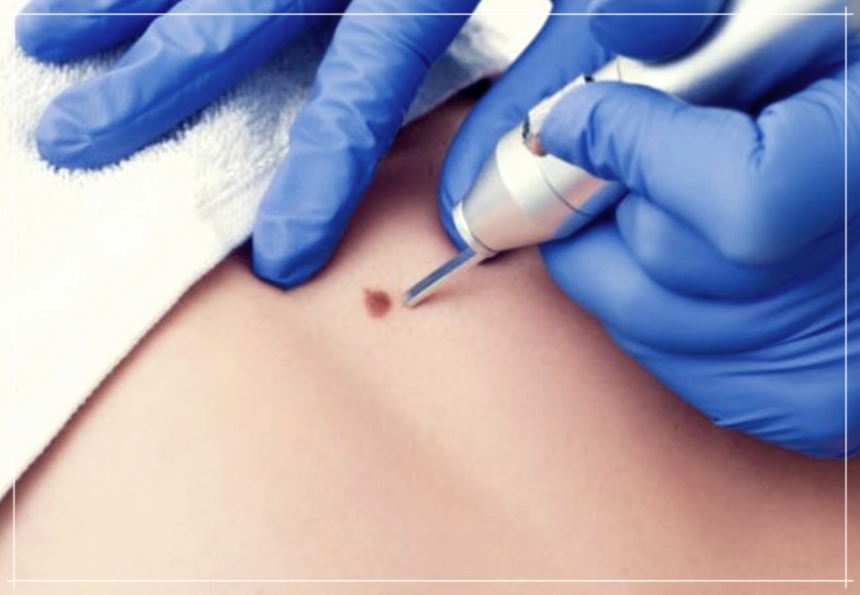 사타구니 쥐젖 치료비용에 대해 알아보기