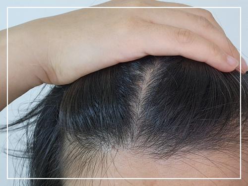 탈모 예방 방법 알아보고 예방