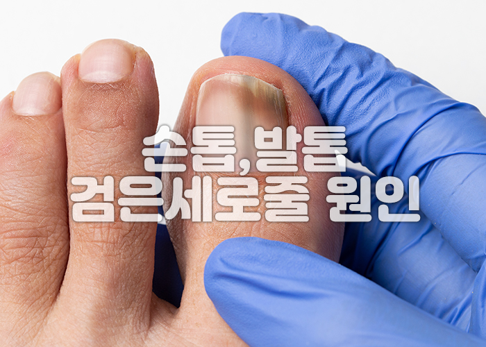 엄지발톱에 검은세로줄이 있다