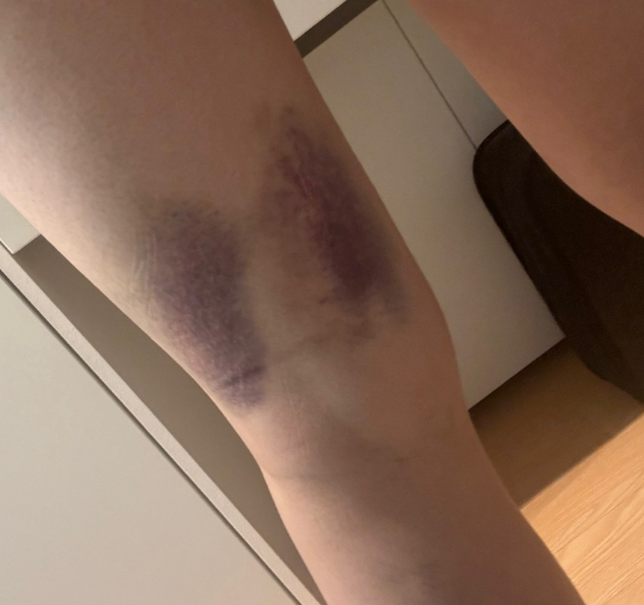 전 남자 친구로부터 상습적인 폭행과 스토킹 피해를 호소해 온 20대 여성이 부산의 한 오피스텔에서 추락해 숨진 사건과 관련해 유가족이 가해자 엄벌을 호소했다. 사진은 유족이 공개한 피해 여성 다리에 멍. [사진=온라인커뮤니티 캡처]