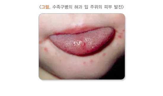 수족구병 증상과 예방 조치 방법 모음_8