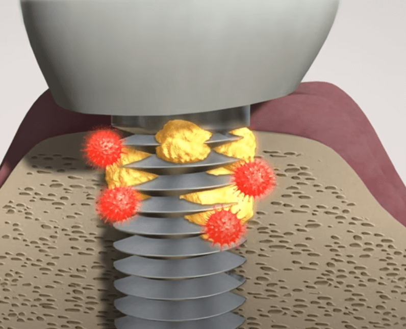 임플란트 주위염 ; 증상&amp;#44; 원인&amp;#44; 예방 및 관리방법 알아보기(재수술&amp;#44; 부작용&amp;#44; 재식립)