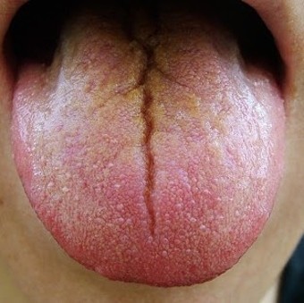 혀 갈라짐 원인