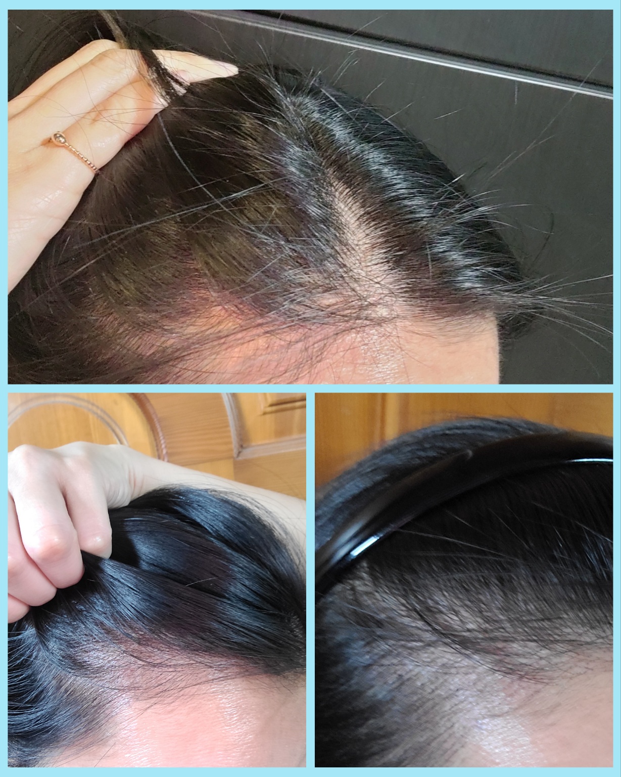 콤마더문 강남 SMP두피문신 1차 왼쪽 헤어라인 교정