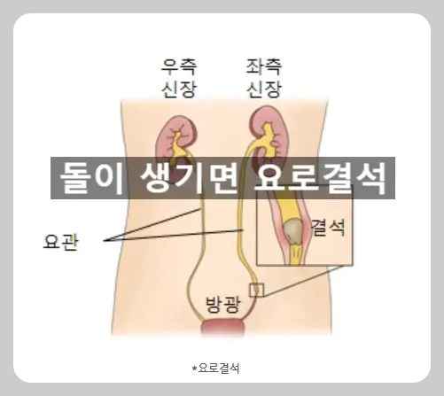 요로결석