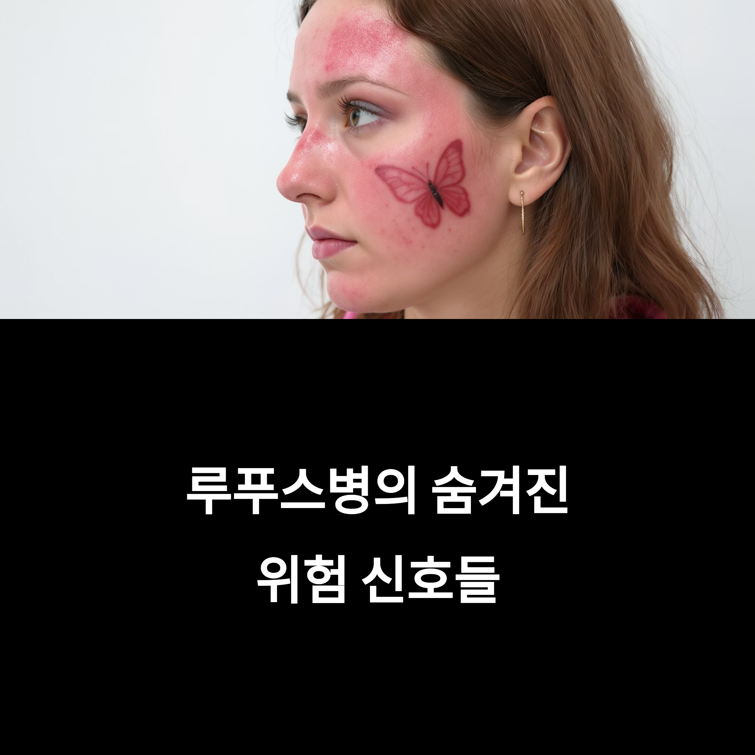 얼굴에 나비 모양 발진이 나타난 여성과 '루푸스병의 숨겨진 위험 신호들'이라는 문구가 있는 이미지