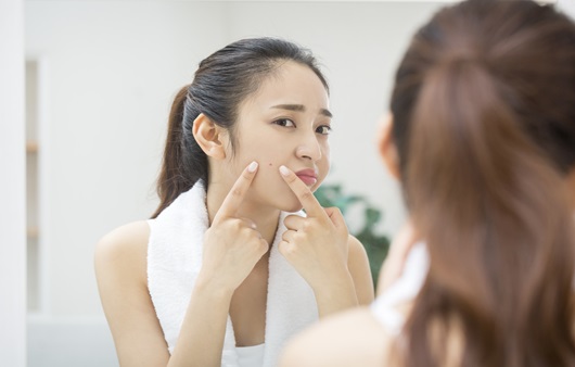월경 전 호르몬 변화가 여드름을 유발