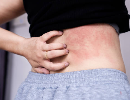 아토피 가려움증