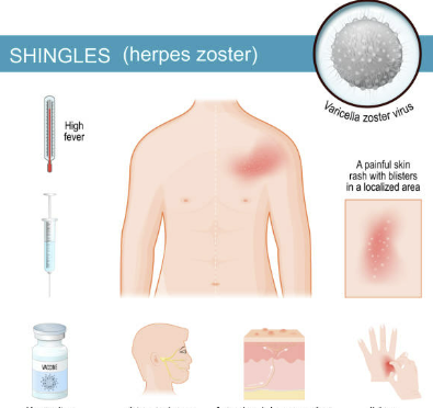 대상포진 예방접종 가격(최저가) 초기증상 치료방법 총정리