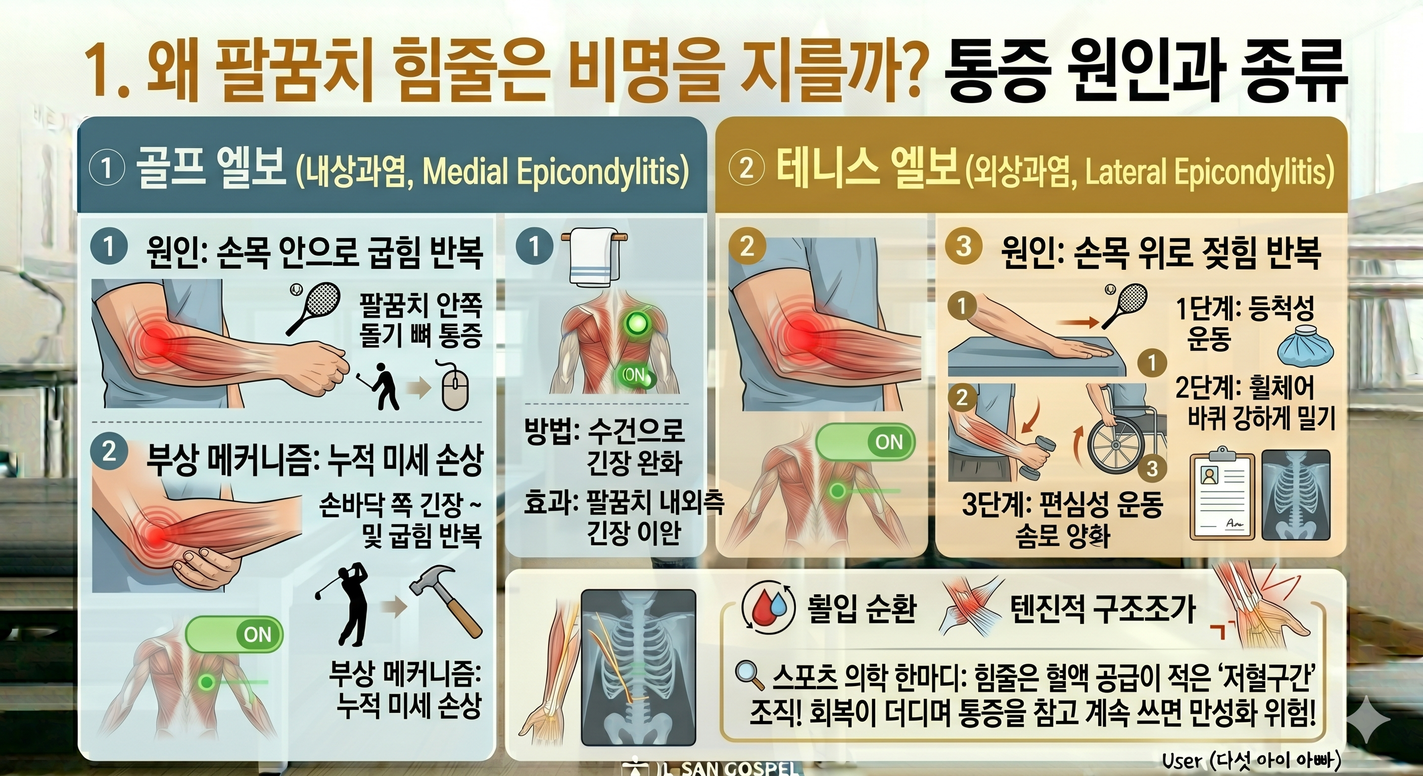 왜 팔꿈치 힘줄은 비명을 지를까? 통증 원인과 종류