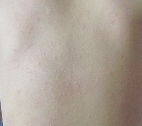 땀띠 가라앉히는 방법 1