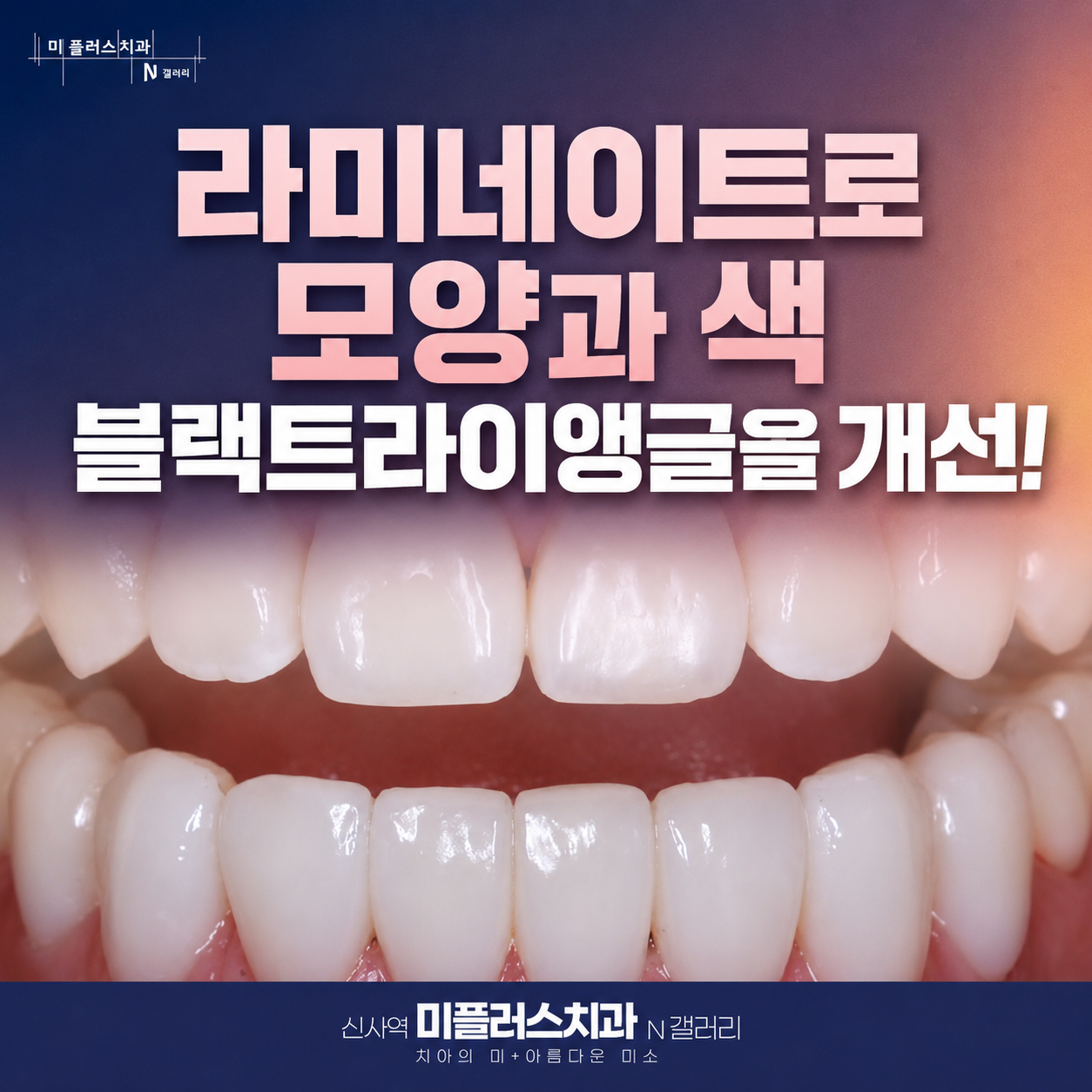 라미네이트 치료로 앞니 모양과 색상, 블랙트라이앵글을 개선한 사례