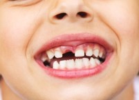 윗쪽-앞니가-빠진-어린이