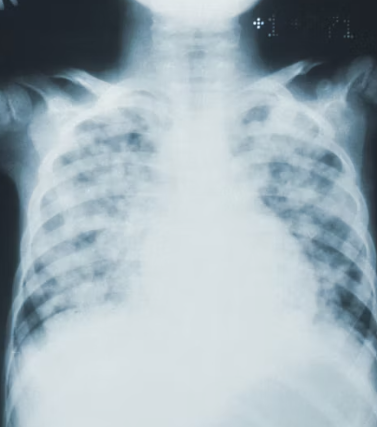 오른쪽 갈비뼈 아래 통증 원인 대처법