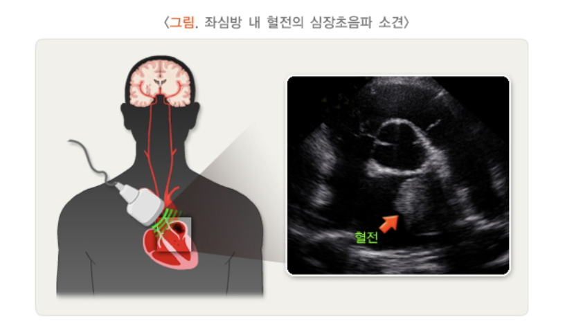 심장 초음파 소견