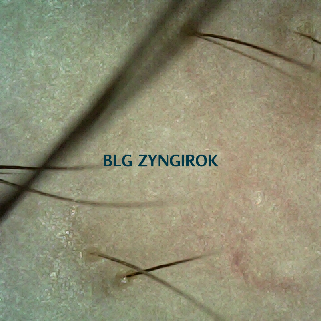 피나모아 복용 3주차 오른쪽 M자 부위 두피 모발 사진이다.