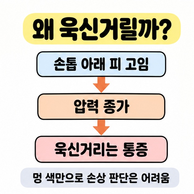 손톱 아래 피 고임에서 압력 증가와 욱신거리는 통증으로 이어지고 멍 색만으로 손상을 판단하기 어렵다고 안내한 도식