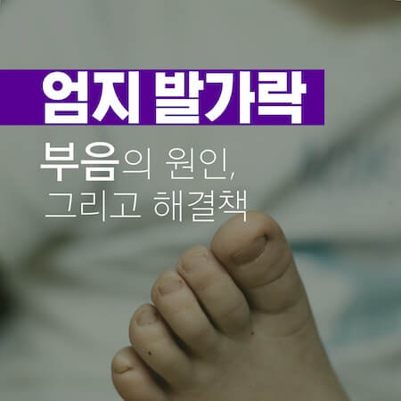 엄지-발가락-부음-썸네일
